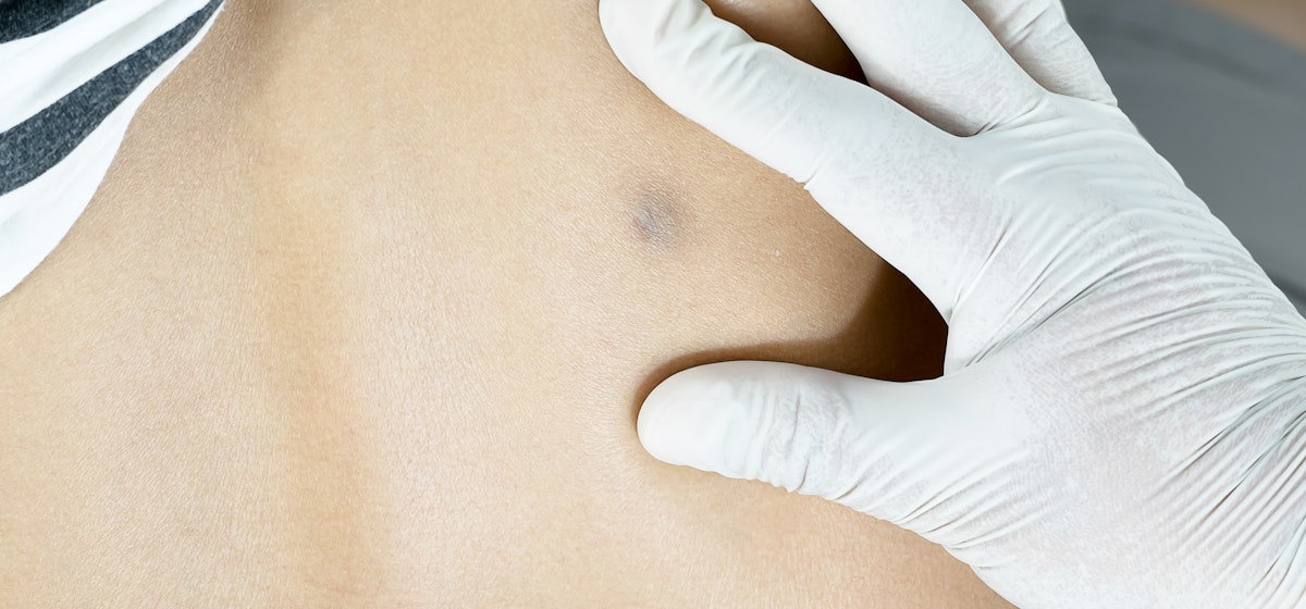 9 Causes For Bumps On Back What You Need To Know Buoy