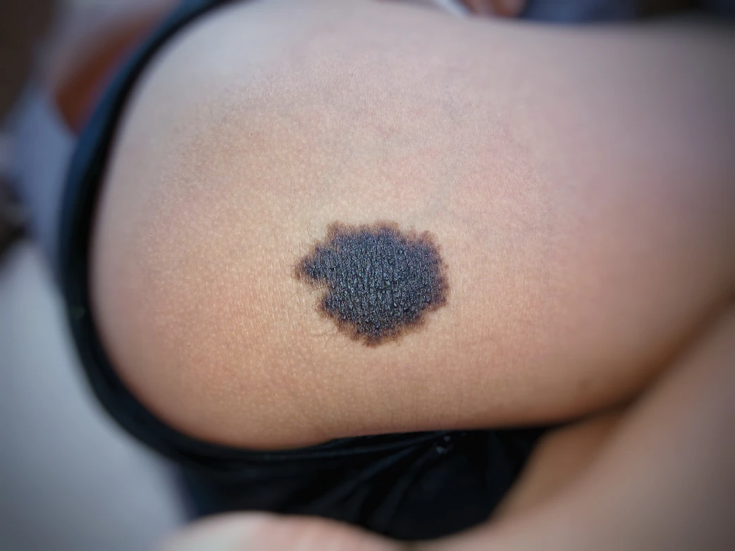 Black Or Brown Butt Bump Symptoms Causes Common Questions Buoy