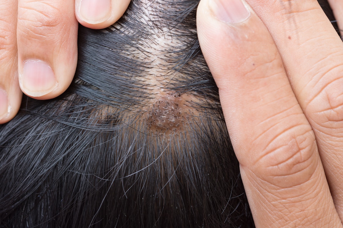 Black Or Brown Scalp Bump Symptoms Causes Common Questions Buoy