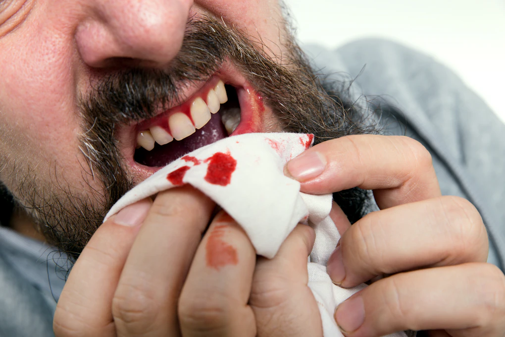 Bleeding Gums Symptoms Causes Common Questions Buoy Bleeding Gums Symptoms Causes Common Questions Buoy
