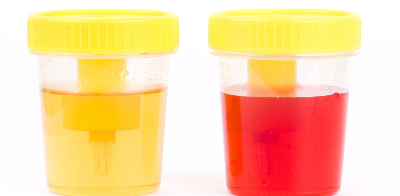 An image depicting a person suffering from bright red (bloody) urine symptoms
