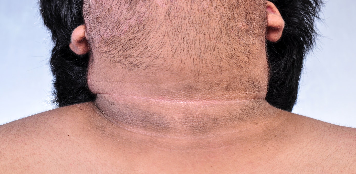 An image depicting a person suffering from darkened skin over the neck symptoms