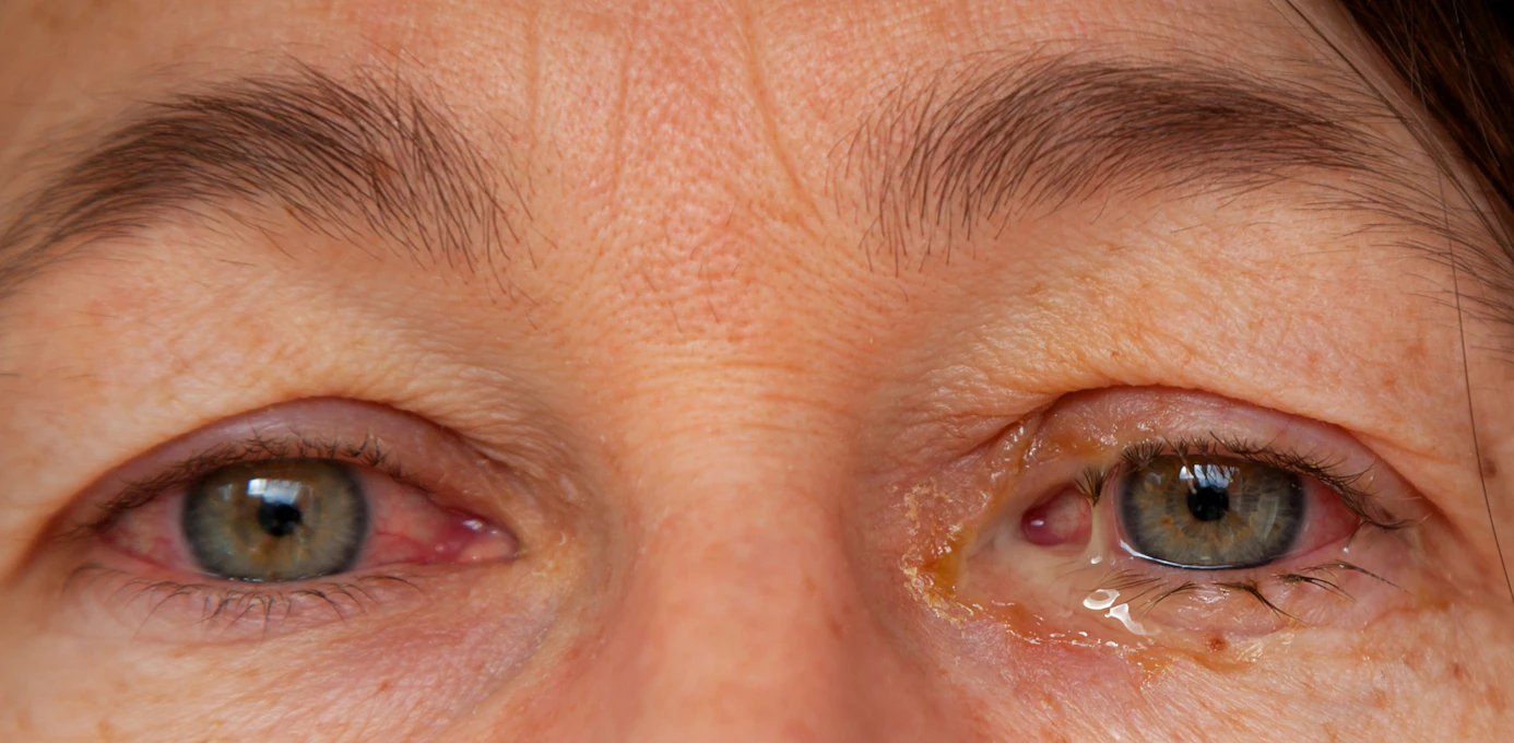 Sinus Infection Pink Eye Allergies Top 9 Eye Discharge Causes Buoy