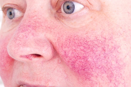 Treatment For Redness On Skin Image Not Available Rosacea
