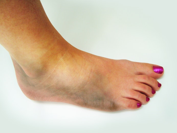Foot Bruise Symptoms Causes Common Questions Buoy