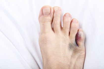 Injuries That Cause Bruised Toe or Foot Buoy Injuries That Cause Bruised Toe or Foot Buoy