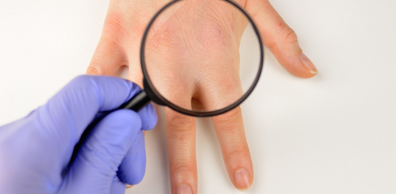 An image depicting a person suffering from hand skin changes symptoms