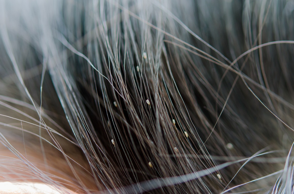 Head Lice Symptoms Causes Treatment Options Buoy