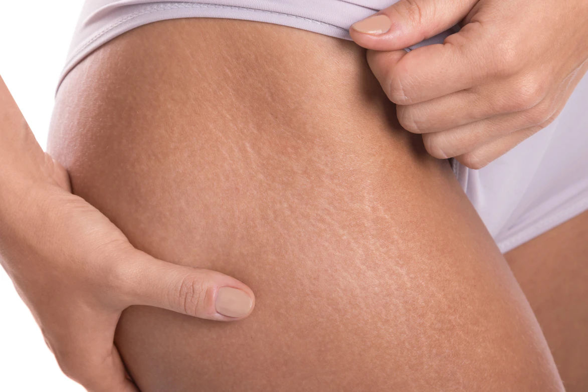 Reasons For Hip Skin Changes Why You May Have Itchy Hips Buoy