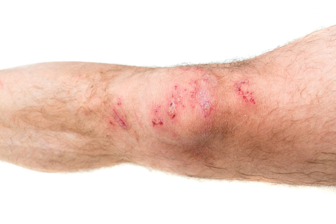 Knee Bump Symptoms Causes Common Questions Buoy