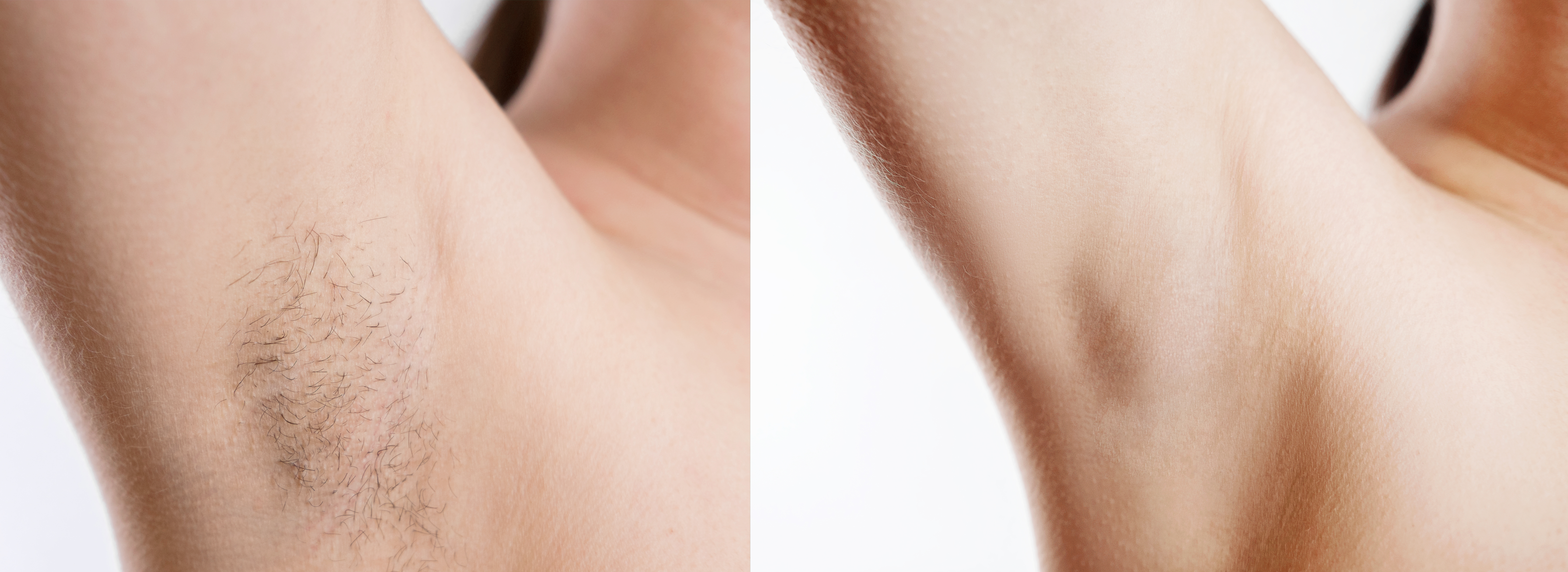 Loss Of Armpit Pubic Hair Symptoms Causes Common Questions Buoy