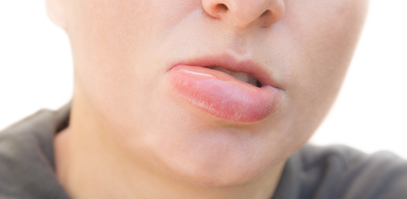An image depicting a person suffering from moderate face swelling symptoms