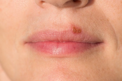 Mouth Sore Resembling Oral Herpes Symptom Causes And Questions Buoy