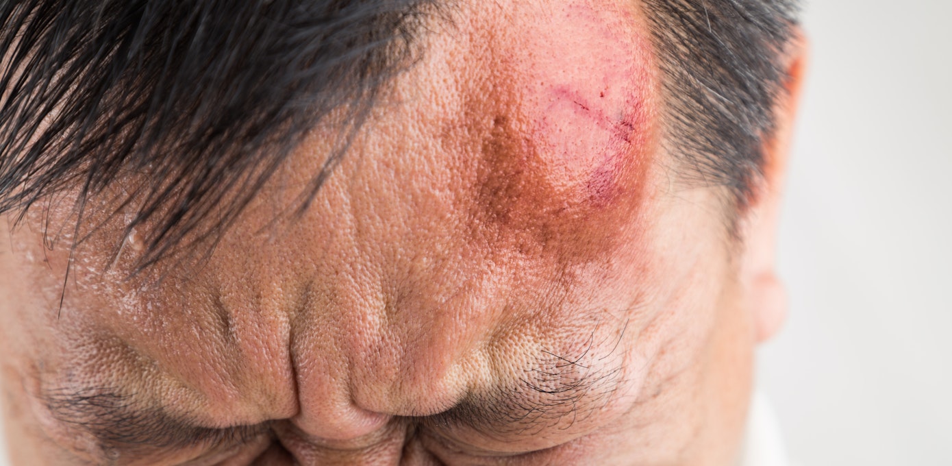 An image depicting a person suffering from movable scalp bump symptoms