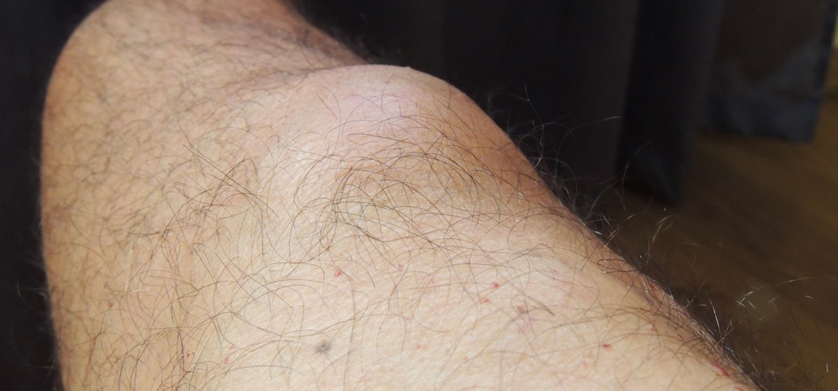 Painless Lump On Thigh When To Worry About A Lump On Inner Thigh
