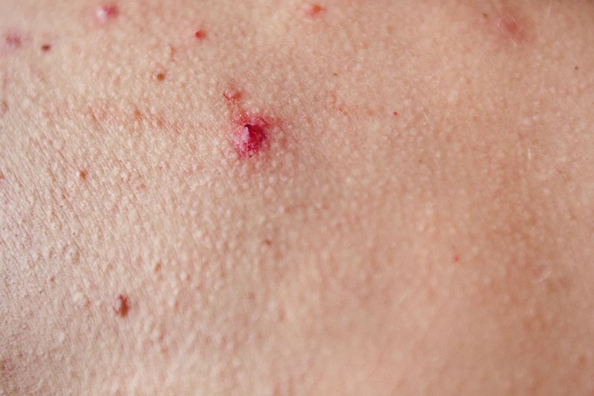 Pink Or Red Butt Bump Symptoms Causes Common Questions Buoy