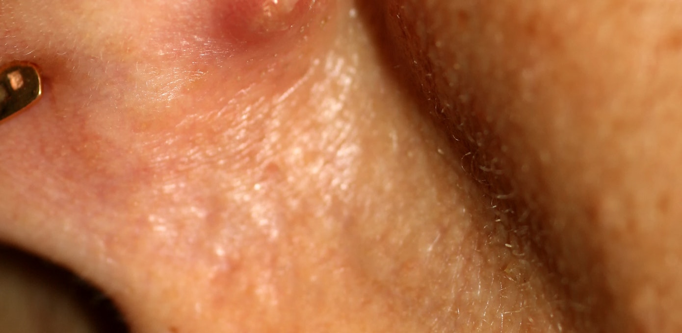 An image depicting a person suffering from pink or red ear bump symptoms