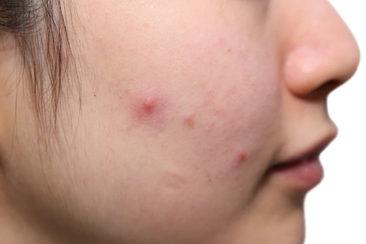 Pink Or Red Facial Bump Symptoms Causes Common Questions Buoy