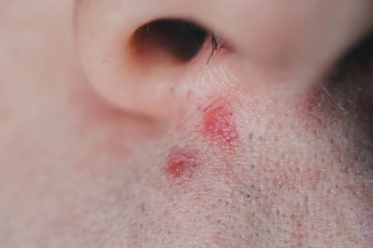 9 Causes For A Red Spot On The Nose Buoy