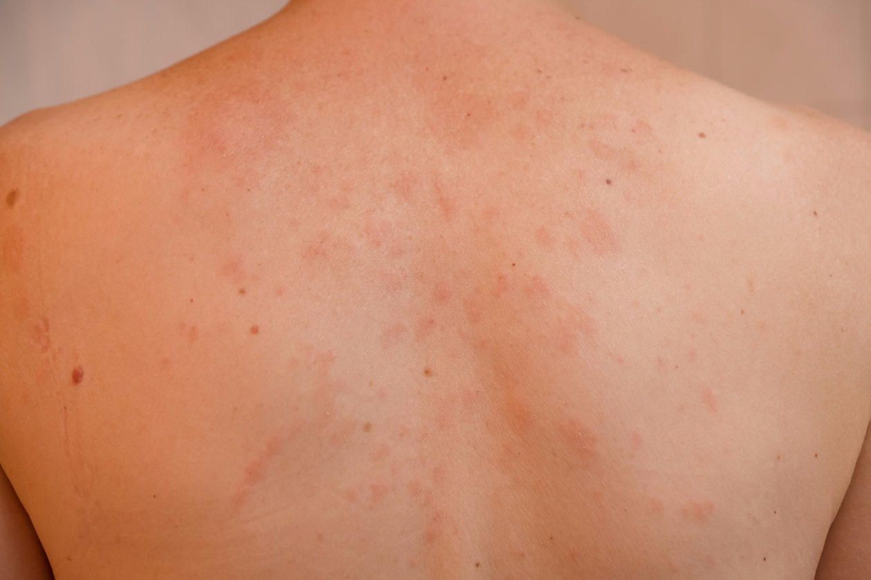 Red rash on cock - 2020 on Red cock rash