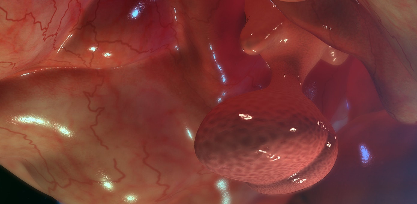 An image depicting a person suffering from prolactinoma symptoms