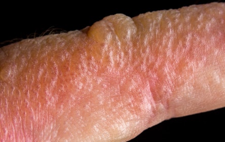 rash-with-bumps-or-blisters-symptom-causes-questions-buoy