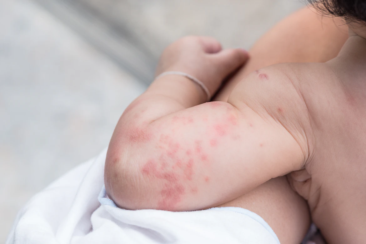 Red Rash Symptoms Causes Common Questions Buoy