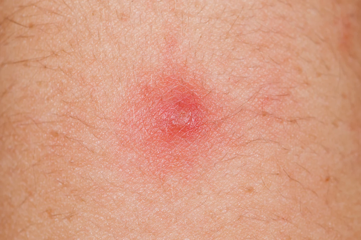 Red Skin Bump Larger Than 1 2 Cm In Diameter Symptoms Causes Buoy