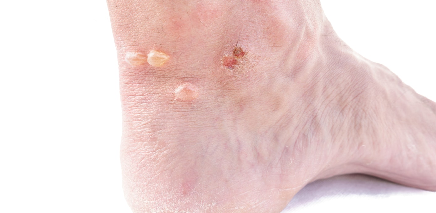 An image depicting a person suffering from skin-colored ankle bump symptoms