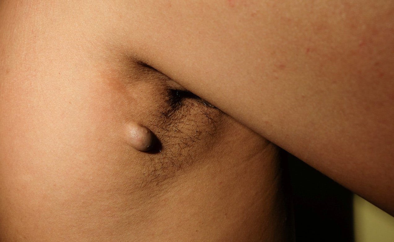 Skin Colored Armpit Bump Symptoms Causes Common Questions Buoy