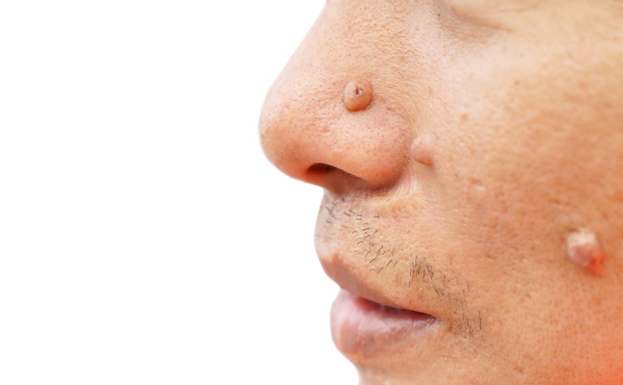 Skin Colored Nose Bump Symptoms Causes Common Questions Buoy