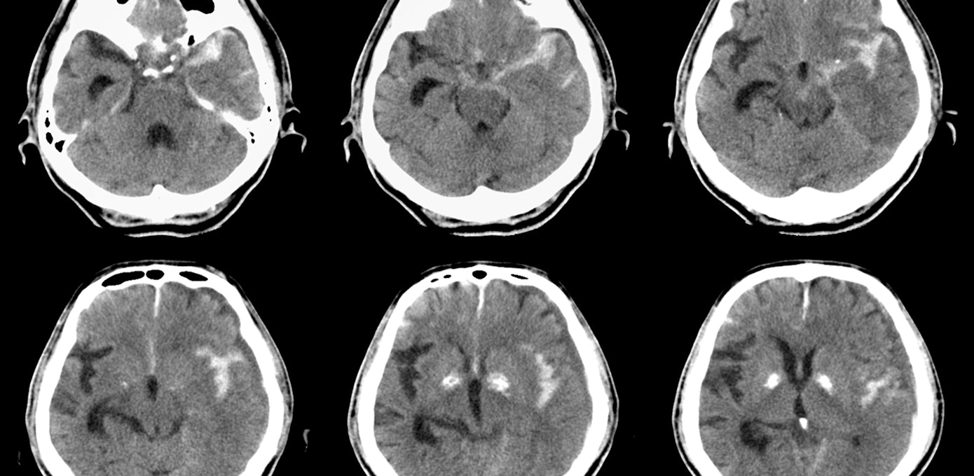 An image depicting a person suffering from Subarachnoid Hemorrhage symptoms