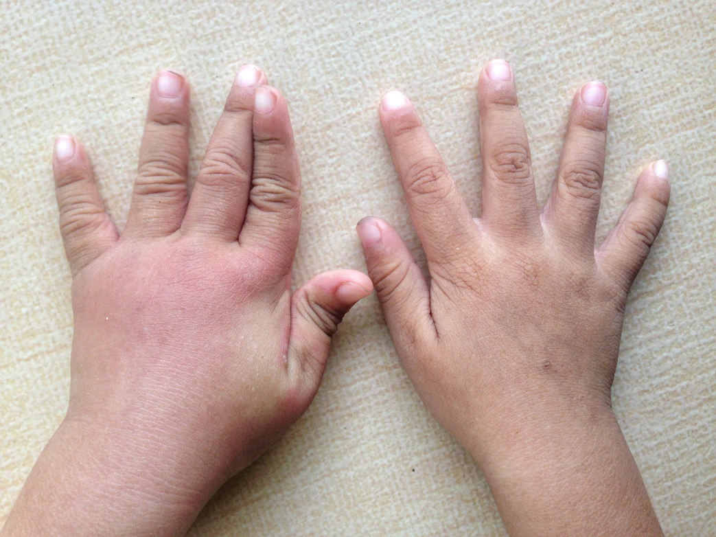 Swelling In Both Hands 9 Causes Treatment And More Buoy