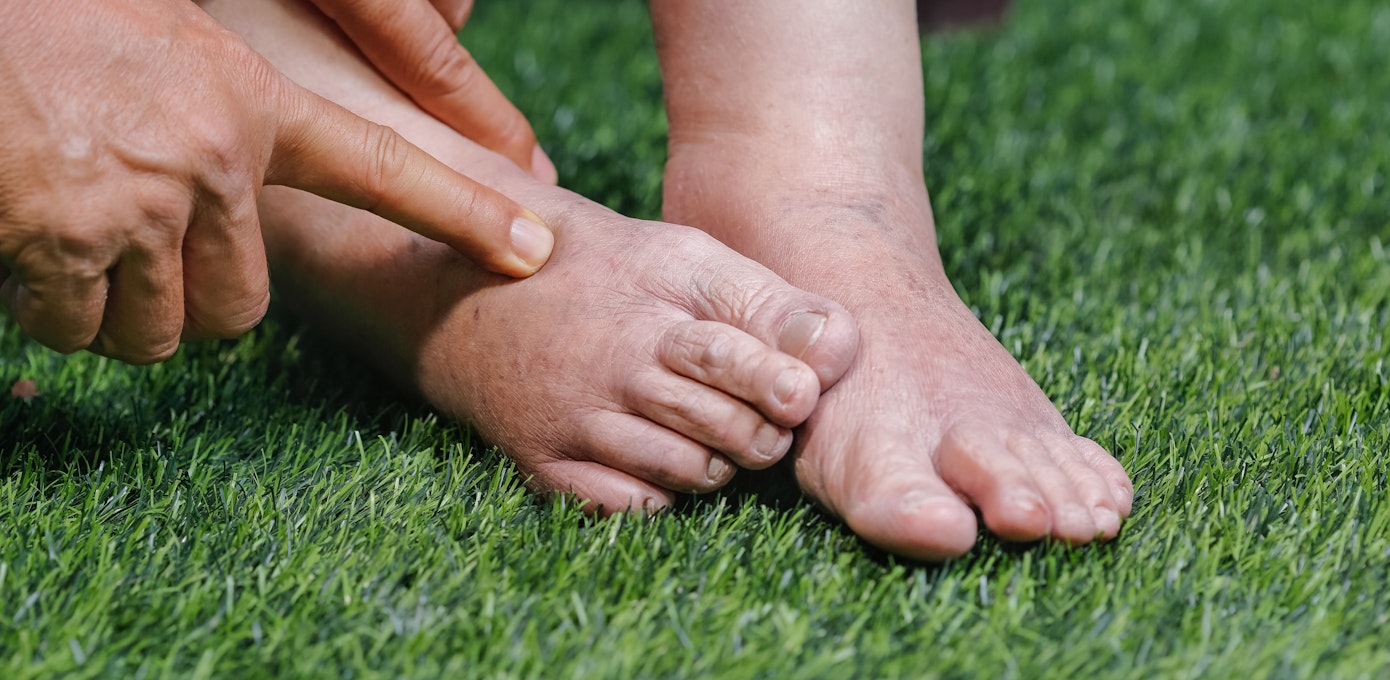 An image depicting a person suffering from swollen ankles symptoms