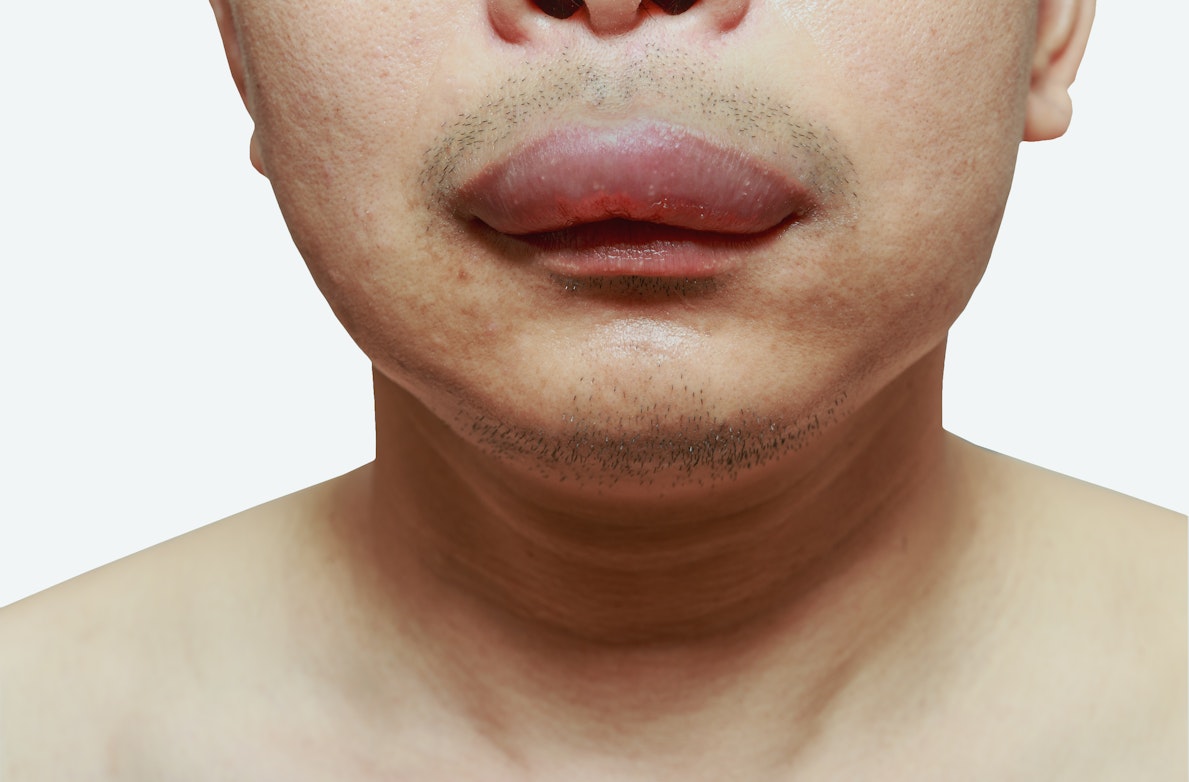 Swollen Mouth 7 Reasons For Mouth Swelling Buoy