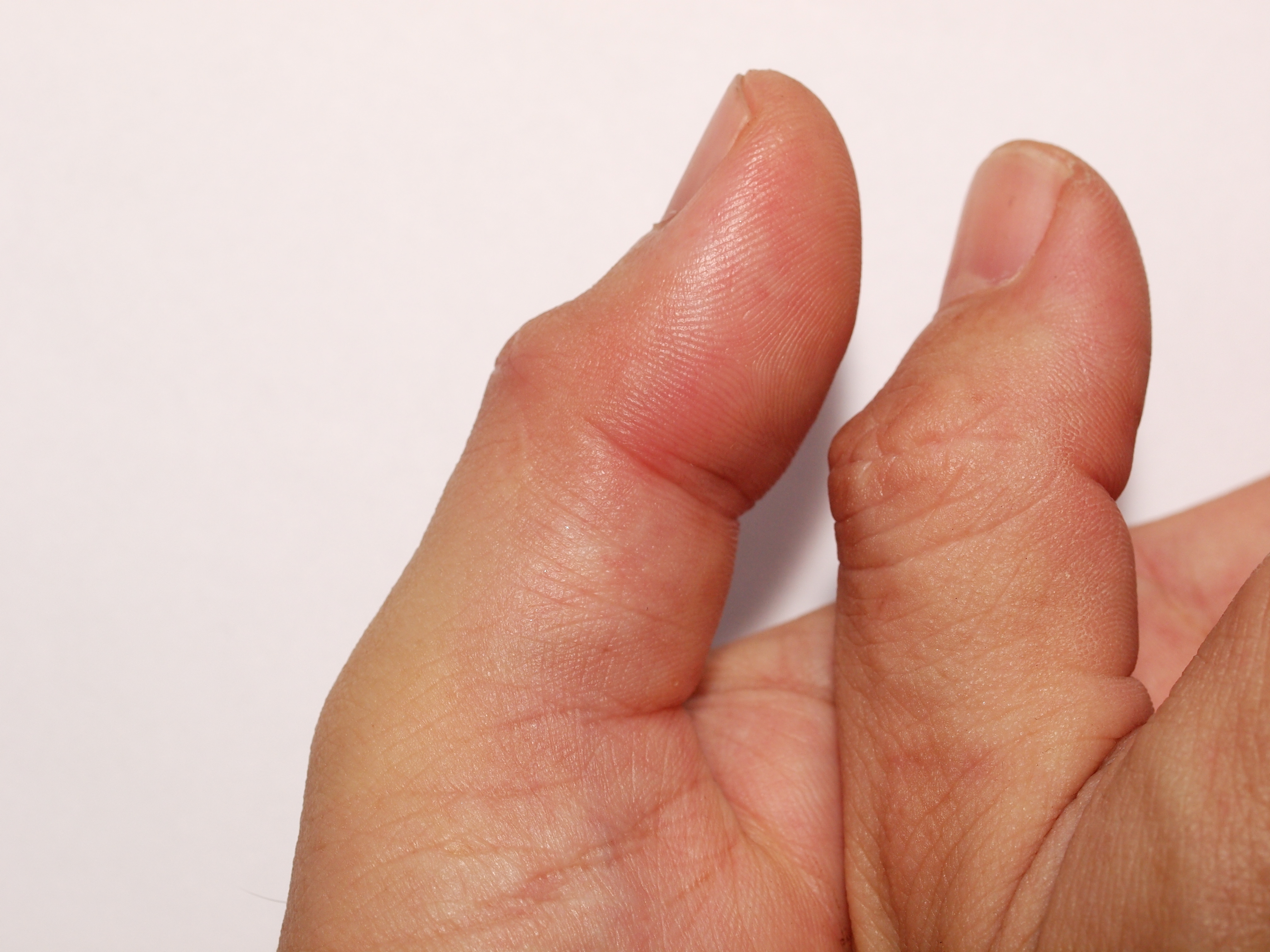 can you get gout in your thumb