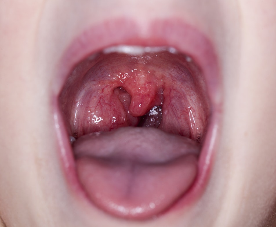 What Does A Swollen Uvula Mean Buoy