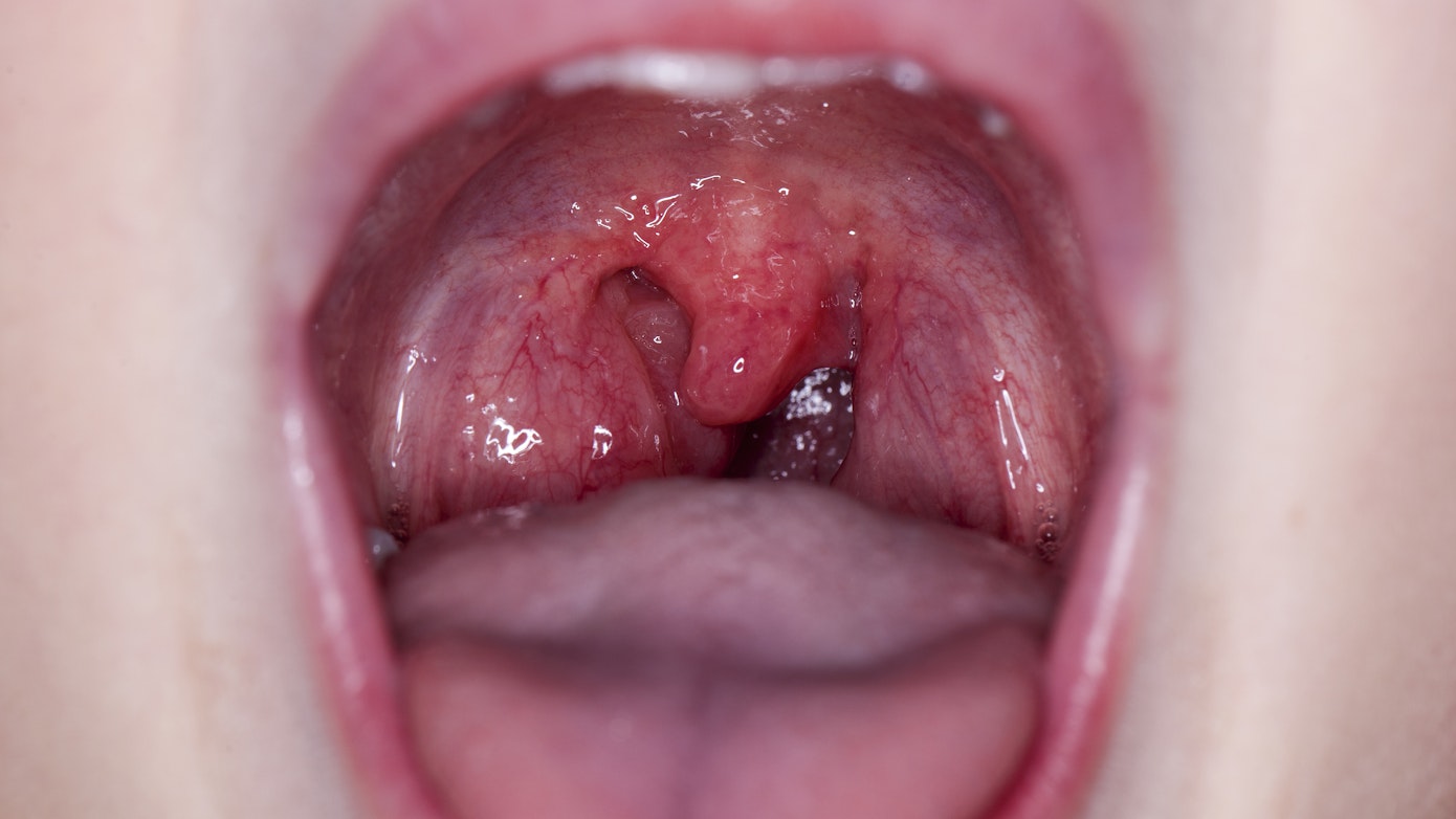 What Does A Swollen Uvula Mean Buoy
