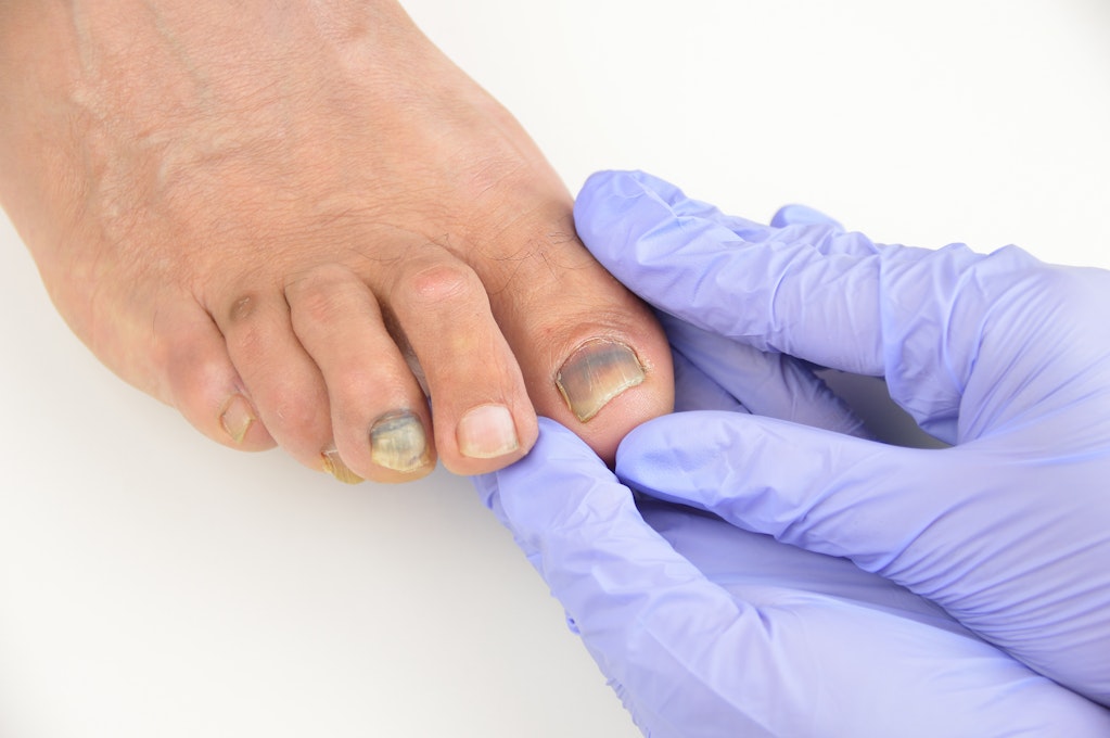 Infection Around Fingernail Skin toenail pain symptom checker