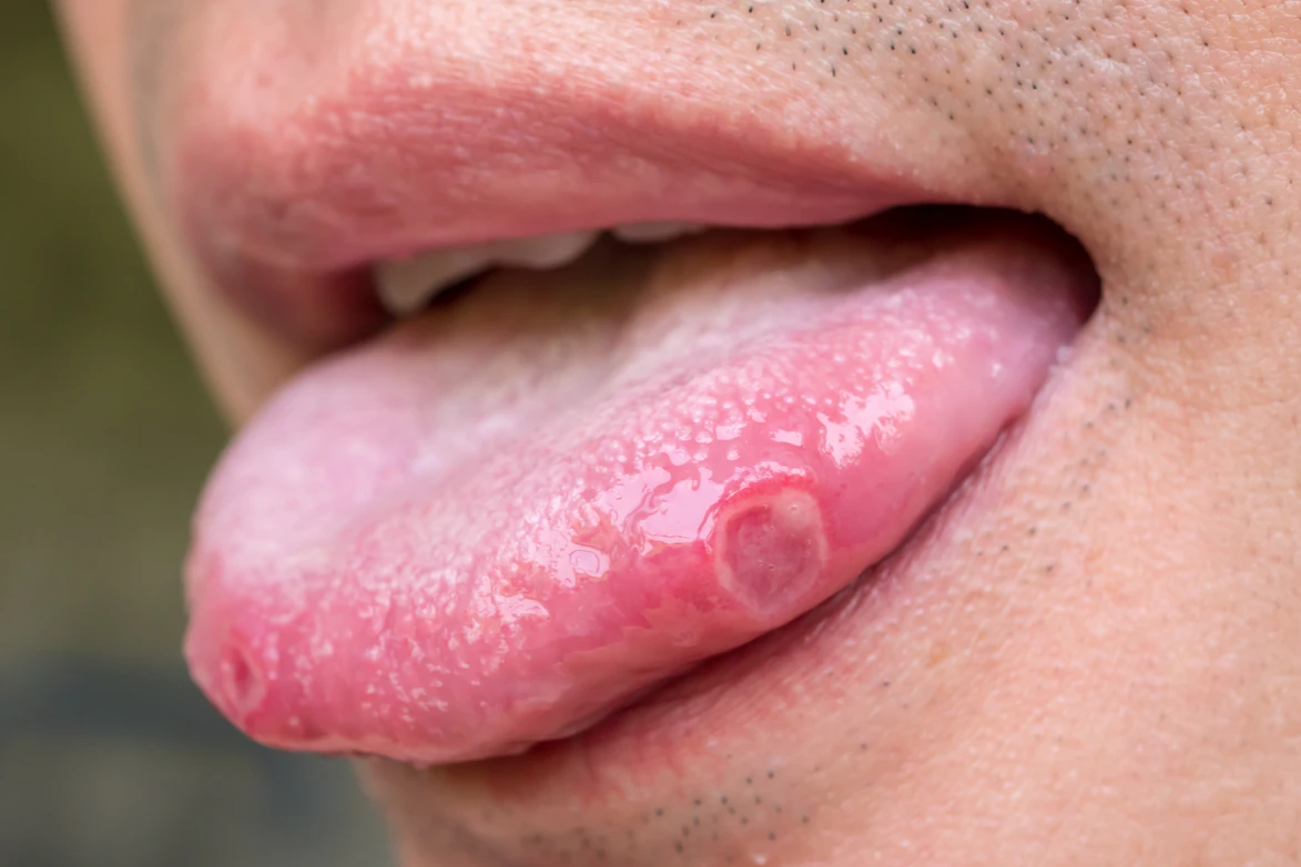 Tongue Sore Symptoms Causes Common Questions Buoy