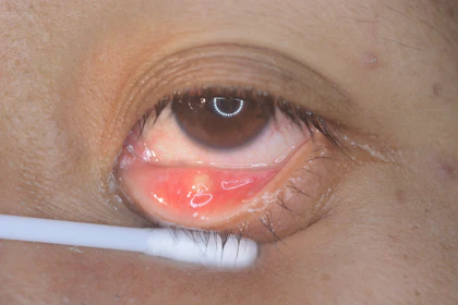 Yellow or White Eye Bump Symptoms, Causes & Common Questions | Buoy