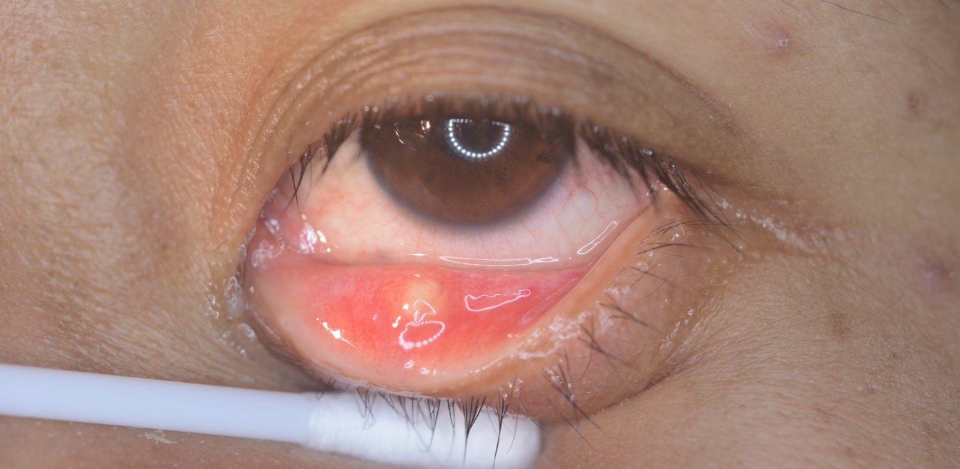 An image depicting a person suffering from yellow or white eye bump symptoms