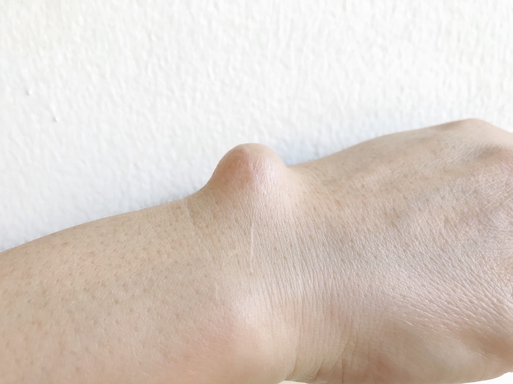 What Causes A Yellow Or White Bump On The Hand Buoy Health